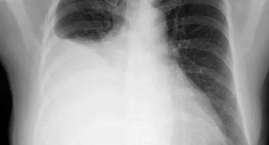 Lung Cancer Specialist & Treatment | Lung Doctor Singapore | Chestmed