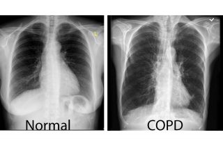 Norman Lung Chronic Obstructive Pulmonary Disease (COPD)