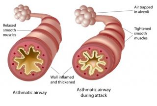 Asthmatic airway treatment Singapore