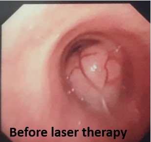 laser bronchoscopy before surgery