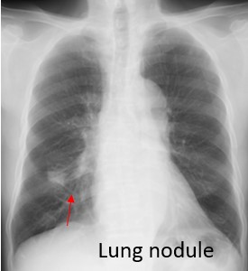 Lung Nodule