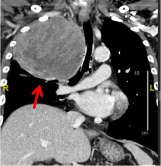 Lung Cancer Specialist & Treatment | Lung Doctor Singapore