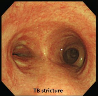 Tuberculosis Treatment Singapore | Tuberculosis Lung Doctor