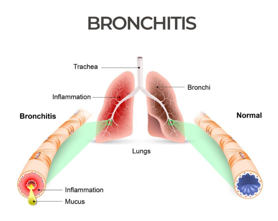 bronchitis treatment